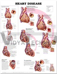 Heart Disease Anatomical Chart, 1st Edition - Paper